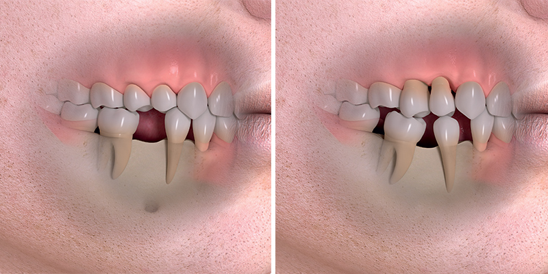 Po ztrátě zubu vzniká mezera ve chrupu. Není-li řešena náhradou, časem se začnou okolní zuby hroutit do mezery. Tím se poškozuje skus a ostatní zuby jsou přetěžované a může dojít ke jejich ztrátě.