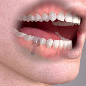 Častokrát je řešení náhrady jednoho zubu implantátem a korunkou levnější než konvenčním mostem.