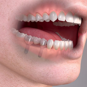 Pokud pacientovi chybí více zubů, lze zavést dva implantáty a na ně nasadit most se třemi až pěti zuby.