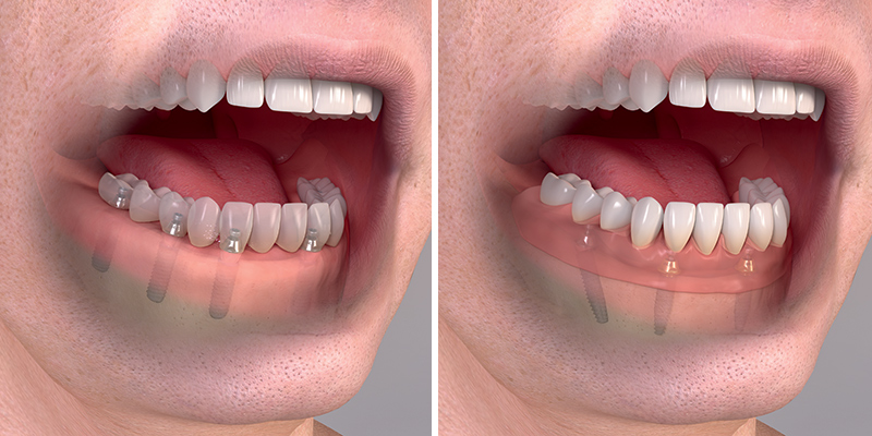 Pokud je zapotřebí nahradit všechny zuby v čelisti, je možné nasadit korunky na šest, nebo dokonce pouze čtyři implantáty. Říkáme tomu koncept "All on four".